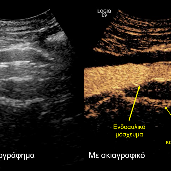 Νέα,πρωτοποριακή τεχνική για τη θεραπεία υπερνεφρικού ανευρύσματος της αορτής από τον 'Ομιλο Ιατρικού Αθηνών,AllTimeClassic