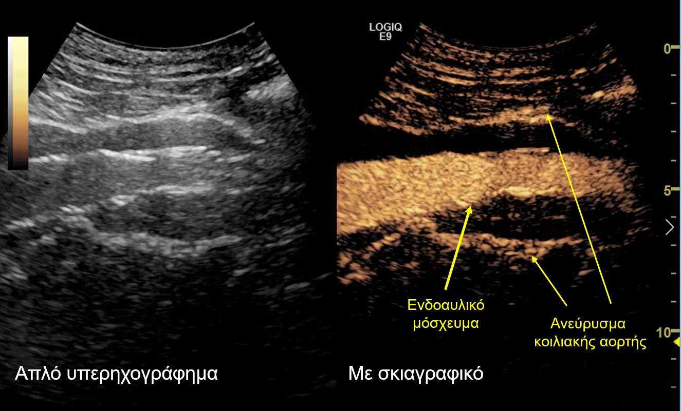 Νέα,πρωτοποριακή τεχνική για τη θεραπεία υπερνεφρικού ανευρύσματος της αορτής από τον 'Ομιλο Ιατρικού Αθηνών,AllTimeClassic